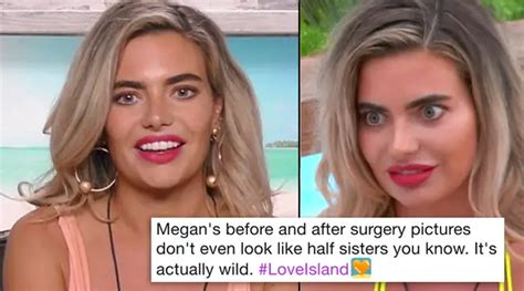 megan before surgery love island